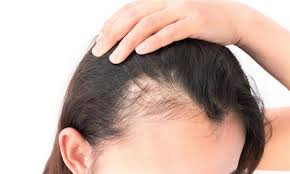 علاج سريع لتساقط الشعر الشديد: 7 اشياء تعرفي عليهم الان